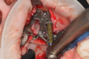 Grooving the Maxillary sinus lateral wall by using a diamond burr