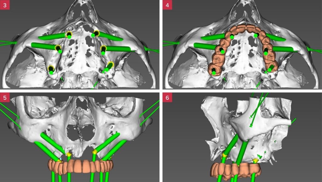 [4-6] Implant positions are planned to support the desired screw-retained rehabilitation