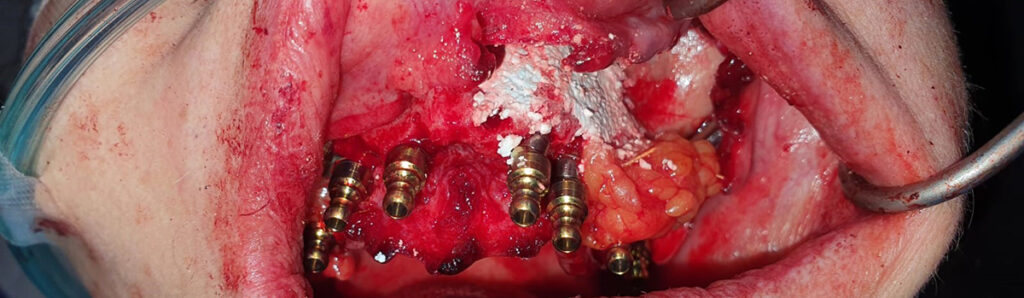 Bone graft augmentation and buccal fat pad advancement was done