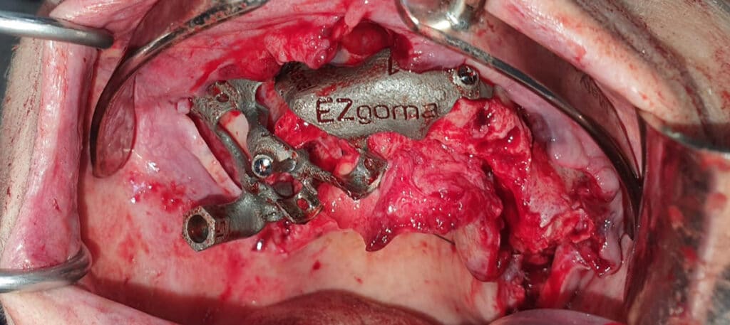 Placing the EZgoma® bone-anchored surgical guide 