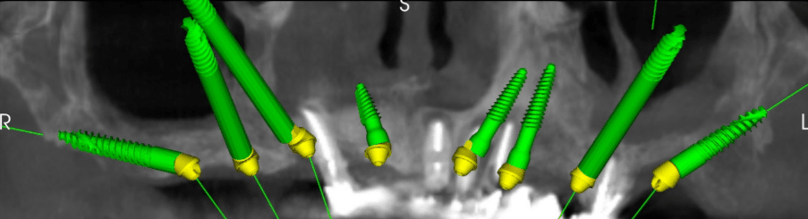 Zygomatic, Pterygoid and regular implants planned positions