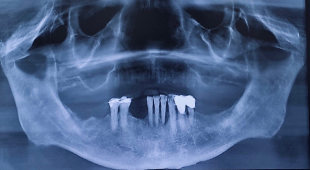 3.Pre-treatment panoramic radiograph showing pneumatized maxillary sinuses, failing mandibular teeth, etc.