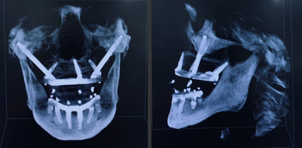 10.Final radiograph after treatment. Maxilla was restored with Noris Medical™ Tuff™ implants, zygomatic implants, and Pteryfit™ implants while the mandible was restored with Noris Medical™ Tuff™ implants. 11. CBCT scan (cranial view )of restored case with zygomatic, pterygoid, vomer, and standard dental implants. 