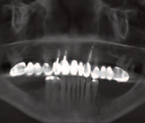 Initial photo and CT scan of the patient, partially edentulous patient, a metal-ceramic bridge of the entire upper part in poor condition along with the teeth that support it.