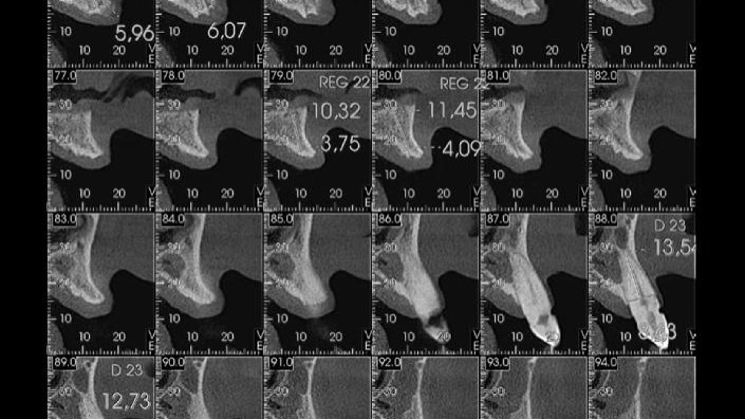 Advanced Full Arch with zygomatic and conventional implants
