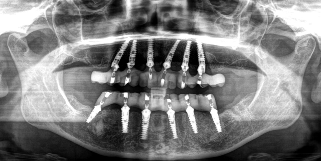 A new beginning: Smile Transformation within hours Full Arch